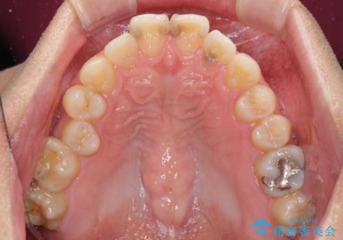顎が左右にずれた咬み合わせ ハーフリンガルの抜歯矯正の治療前