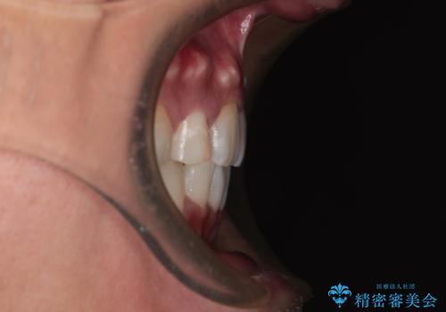 【モニター】八重歯と正中のずれた歯列 片顎抜歯のワイヤー矯正の治療後