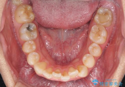 顎が左右にずれた咬み合わせ ハーフリンガルの抜歯矯正の治療前