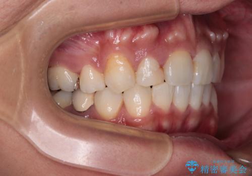 【モニター】八重歯と正中のずれた歯列 片顎抜歯のワイヤー矯正の治療後