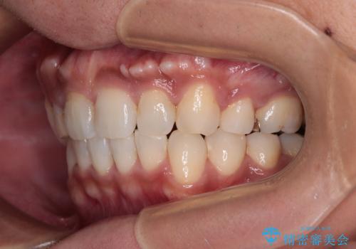 【モニター】八重歯と正中のずれた歯列 片顎抜歯のワイヤー矯正の治療後