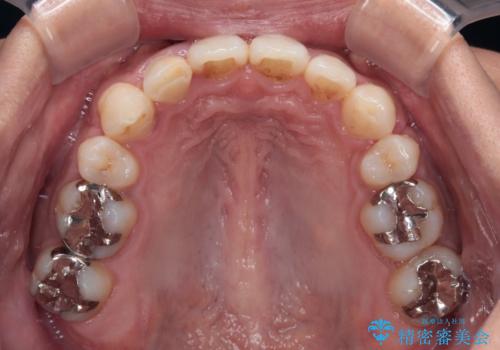 【モニター】八重歯と正中のずれた歯列 片顎抜歯のワイヤー矯正の治療後