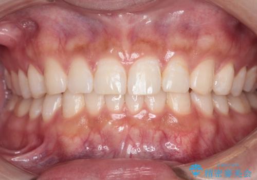 【インビザライン】正中離開を治したいの治療後