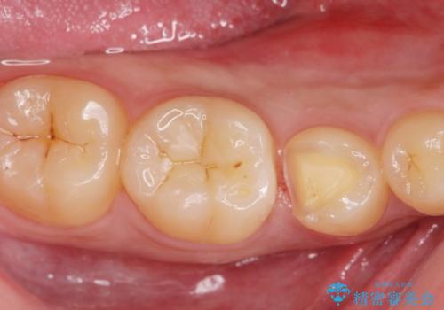 他院で虫歯を指摘された。自費治療希望。の治療中