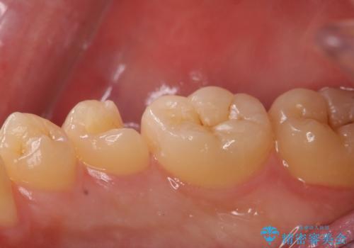 他院で虫歯を指摘された。自費治療希望。の治療中