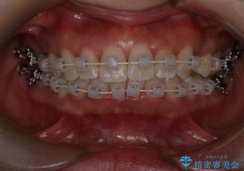 【審美装置】上下の前歯をきれいにしたい の治療中