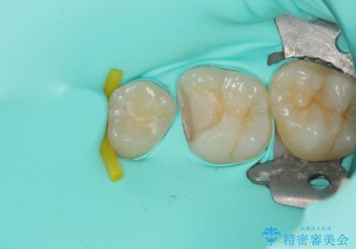 歯に穴が開いた セラミックインレー修復の治療中