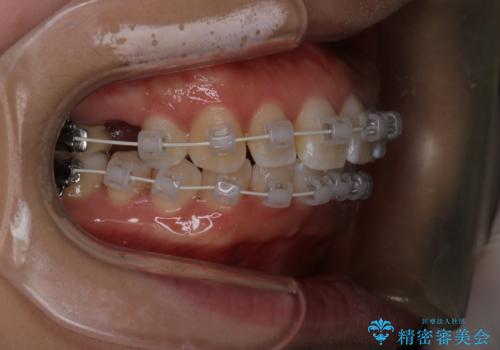 【審美装置】上下の前歯をきれいにしたい の治療中