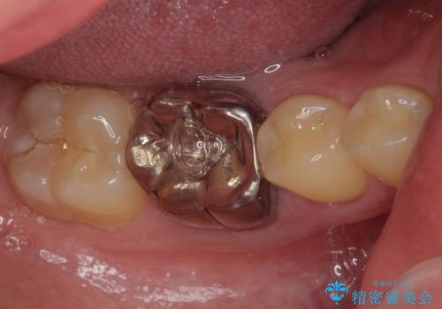 銀歯を白くしたい オールセラミッククラウンの治療前