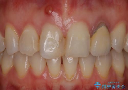 前歯治したい『根管治療 セラミック治療』の治療前