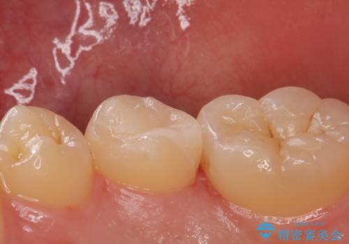 他院で虫歯を指摘された。自費治療希望。の治療後