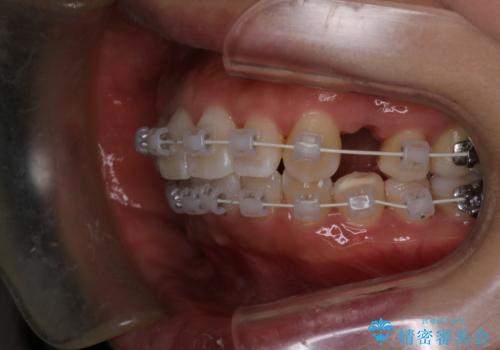 【審美装置】上下の前歯をきれいにしたい の治療中
