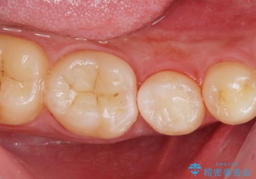 他院で虫歯を指摘された。自費治療希望。の治療後