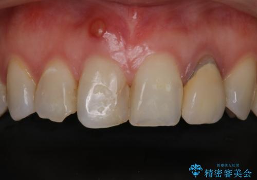 前歯治したい『根管治療 セラミック治療』の治療前