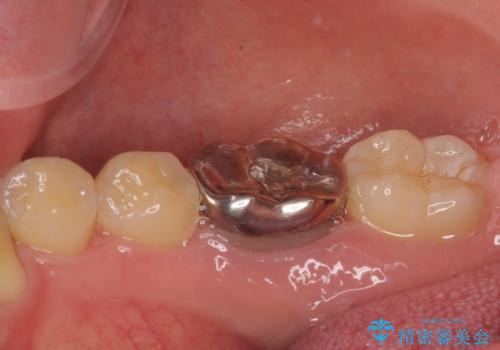 銀歯を白くしたい オールセラミッククラウンの治療前