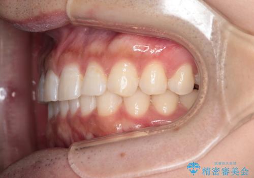 【インビザライン】正中離開を治したいの治療後