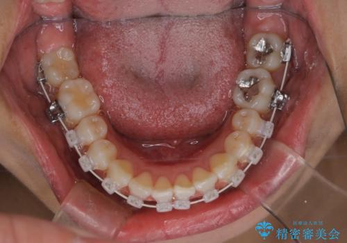 【審美装置】上下の前歯をきれいにしたい の治療中