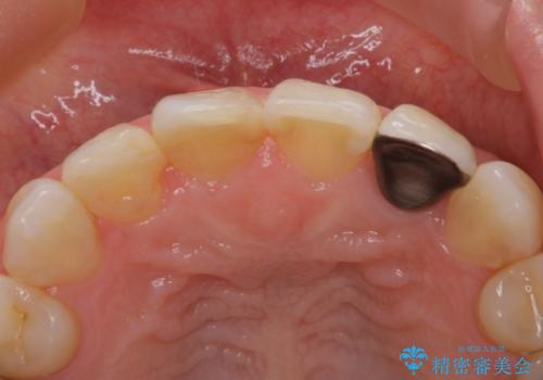 前歯治したい『根管治療 セラミック治療』の治療前