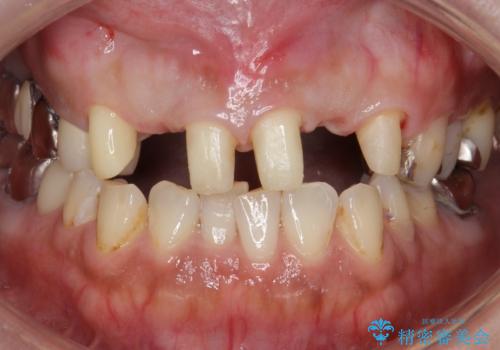 前歯が気になる。ブリッジによる治療。の治療中