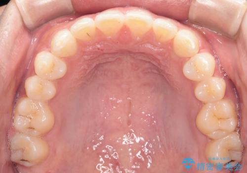 【インビザライン】正中離開を治したいの治療後