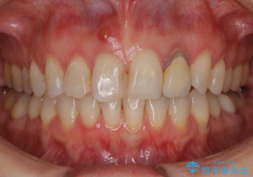 前歯治したい『根管治療 セラミック治療』の症例 治療前