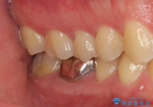 銀歯を白くしたい オールセラミッククラウンの症例 治療前