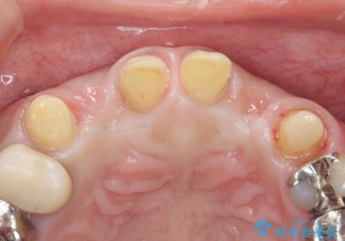 前歯が気になる。ブリッジによる治療。の治療中