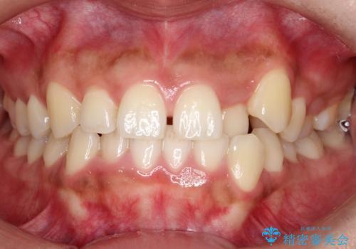 非抜歯で短期間!ワイヤー矯正で理想の歯並びを実現の症例 治療前