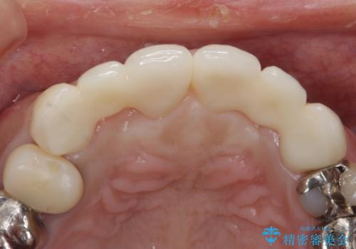 前歯が気になる。ブリッジによる治療。の治療後