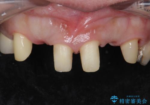 前歯が気になる。ブリッジによる治療。の治療中
