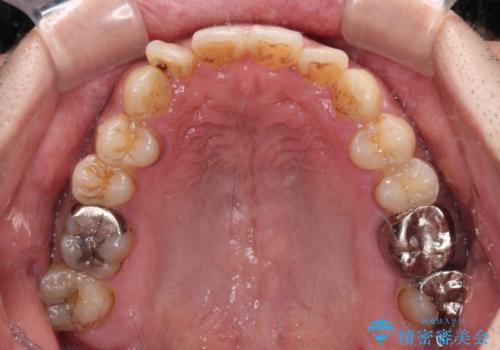 デコボコを治したい インビザラインによる矯正治療の治療中