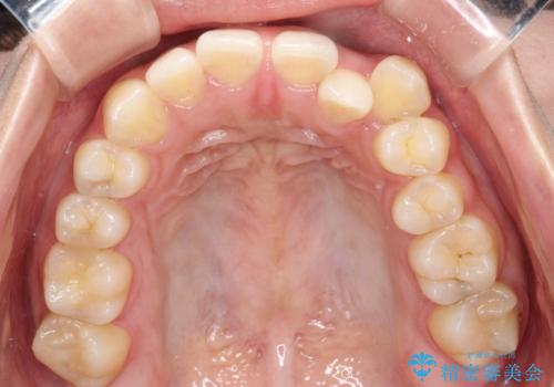 非抜歯で短期間!ワイヤー矯正で理想の歯並びを実現の治療前