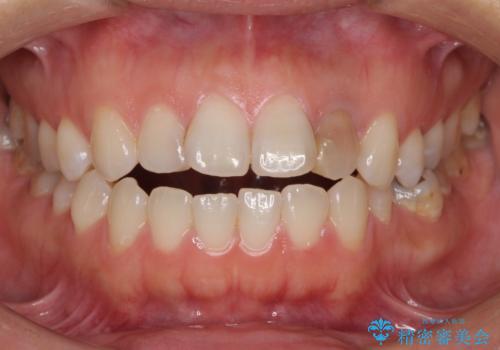 開咬と変色した前歯　インビザライン矯正とオールセラミッククラウン治療の症例 治療前