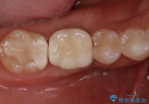 『インプラント』主訴:歯を入れたいの症例 治療後