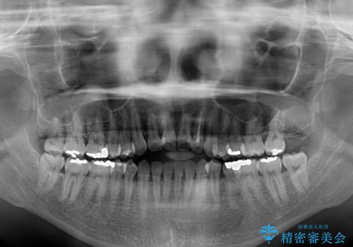 開咬と変色した前歯　インビザライン矯正とオールセラミッククラウン治療の治療前
