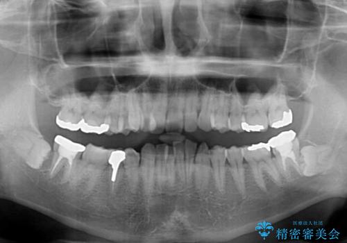 【モニター】八重歯と正中のずれた歯列　片顎抜歯のワイヤー矯正の治療前