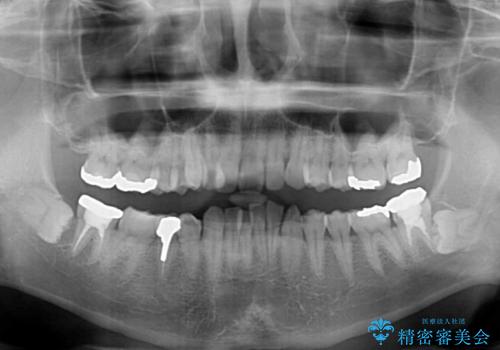 【モニター】八重歯と正中のずれた歯列 片顎抜歯のワイヤー矯正の治療前