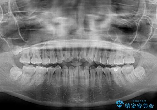 舌の突出癖による開咬と前歯の突出　インビザライン矯正治療の治療前