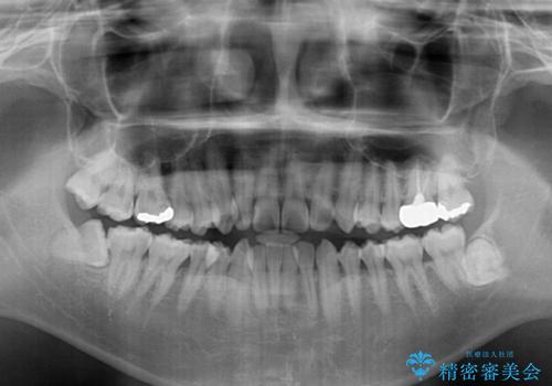 デコボコを治したい　インビザラインによる矯正治療の治療前