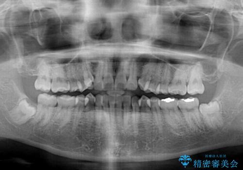 八重歯を治す　非抜歯のワイヤー矯正治療の治療前