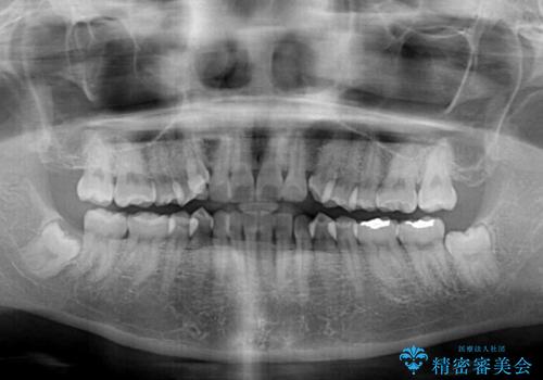 八重歯を治す 非抜歯のワイヤー矯正治療の治療前
