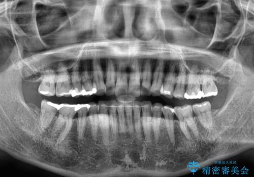 インビザラインが続けられない 忍耐のマウスピース矯正の治療後
