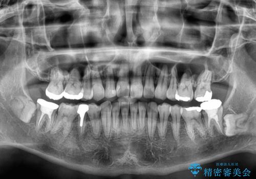 【モニター】八重歯と正中のずれた歯列 片顎抜歯のワイヤー矯正の治療後