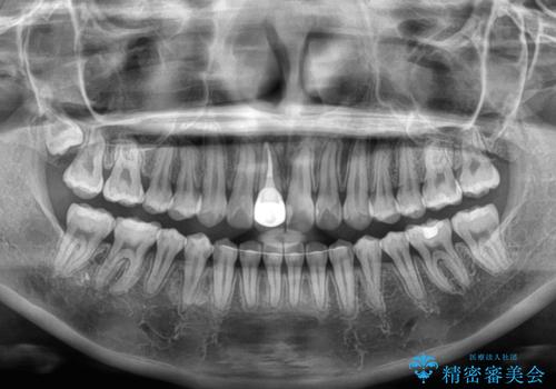 舌の突出癖による開咬と前歯の突出 インビザライン矯正治療の治療後