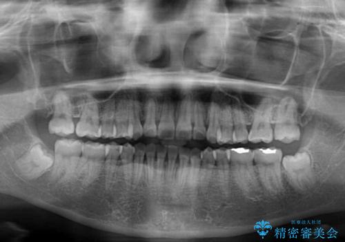 八重歯を治す　非抜歯のワイヤー矯正治療の治療後