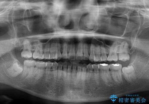 八重歯を治す 非抜歯のワイヤー矯正治療の治療後