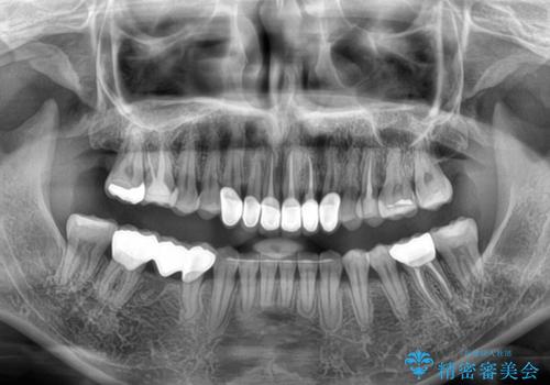 気にしていた歯並びをインビザラインで改善 セラミックも作り替えて綺麗な口元にの治療後