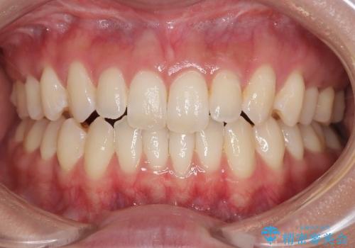 再矯正 前歯のガタツキをマウスピース矯正で治療したいの症例 治療前
