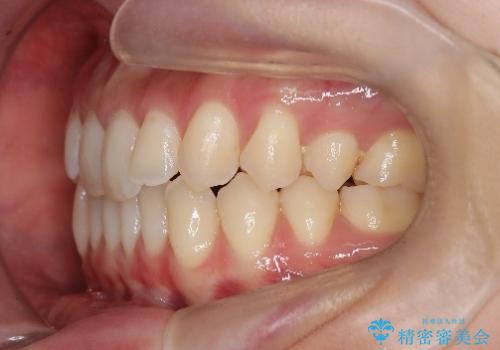 再矯正 前歯のガタツキをマウスピース矯正で治療したいの治療前