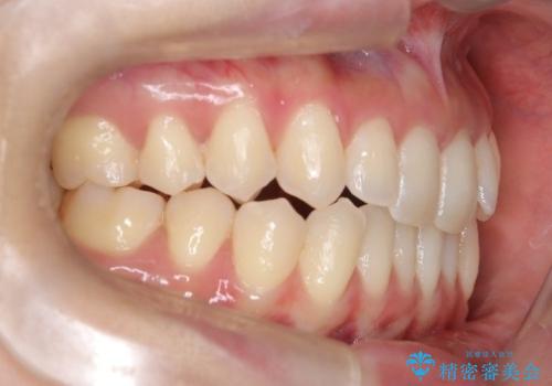 再矯正 前歯のガタツキをマウスピース矯正で治療したいの治療前